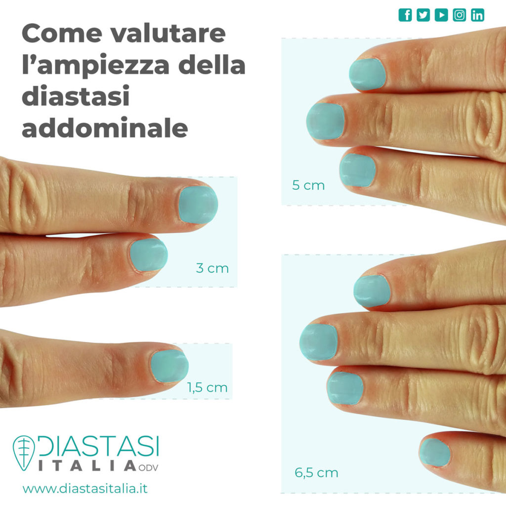 Come si diagnostica la diastasi addominale, i passi da seguire